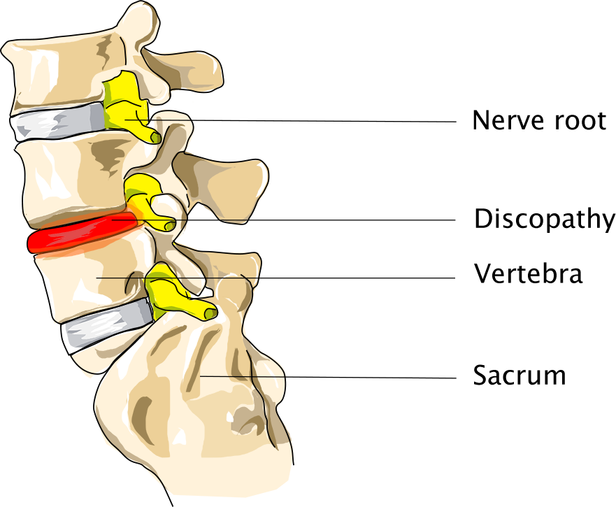 Degenerative Disc Disease