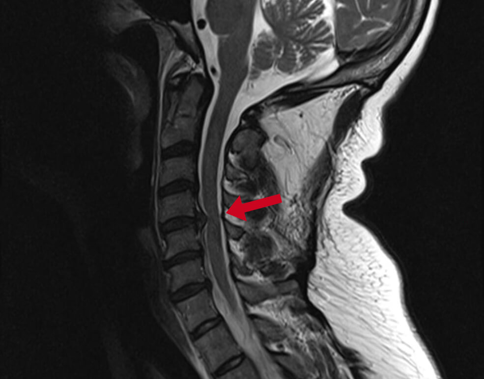 Diagnosis of a neck hernia