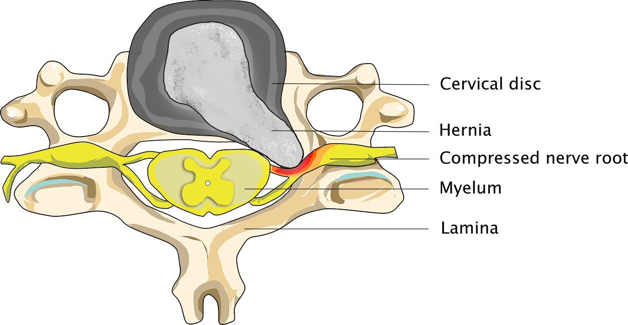 Patient suffering from a neck hernia