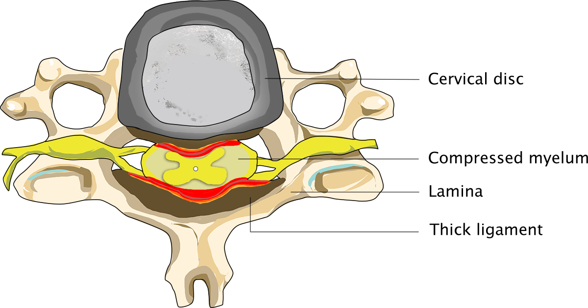 Cervical spinal stenosis