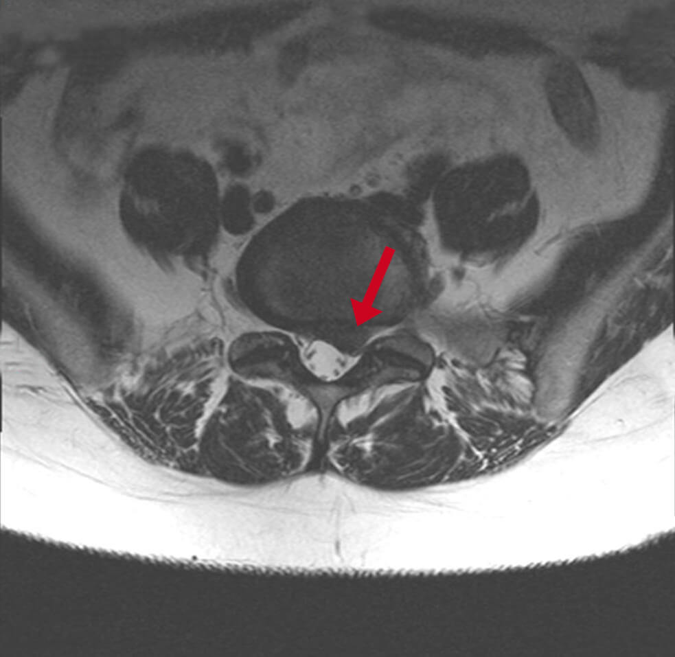 MRI of the spine