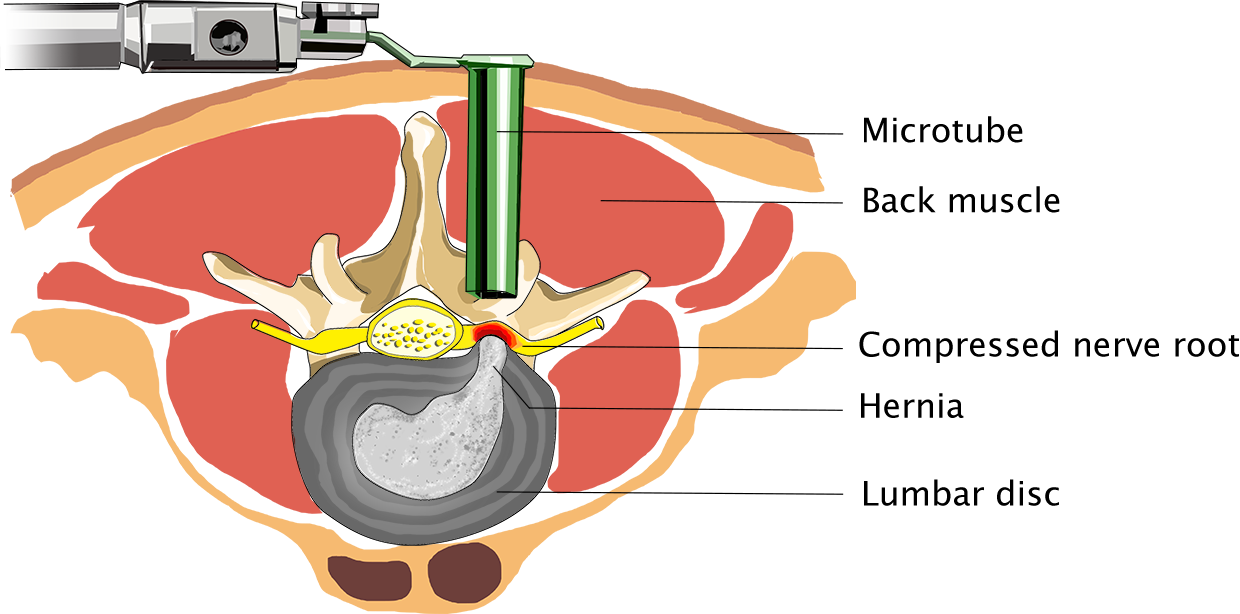 Surgery of a spinal hernia