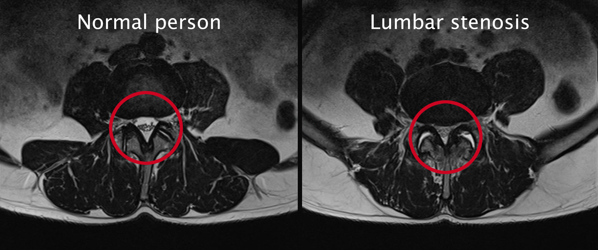 Diagnosis of a lumbar spinal stenosis