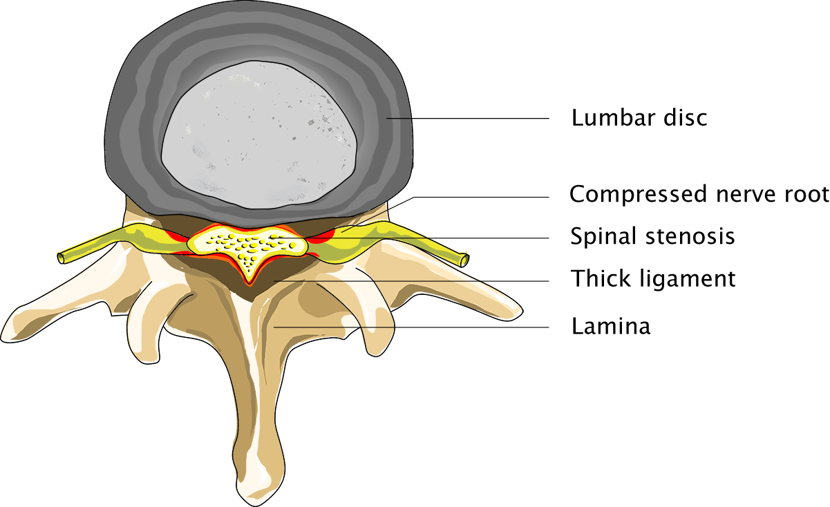 Person suffering from lumbar spinal stenosis